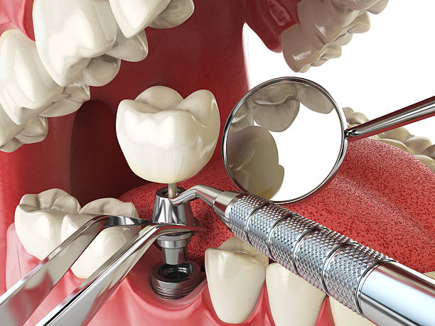 Best Chipped Tooth Repair Near Me  in Knox, PA